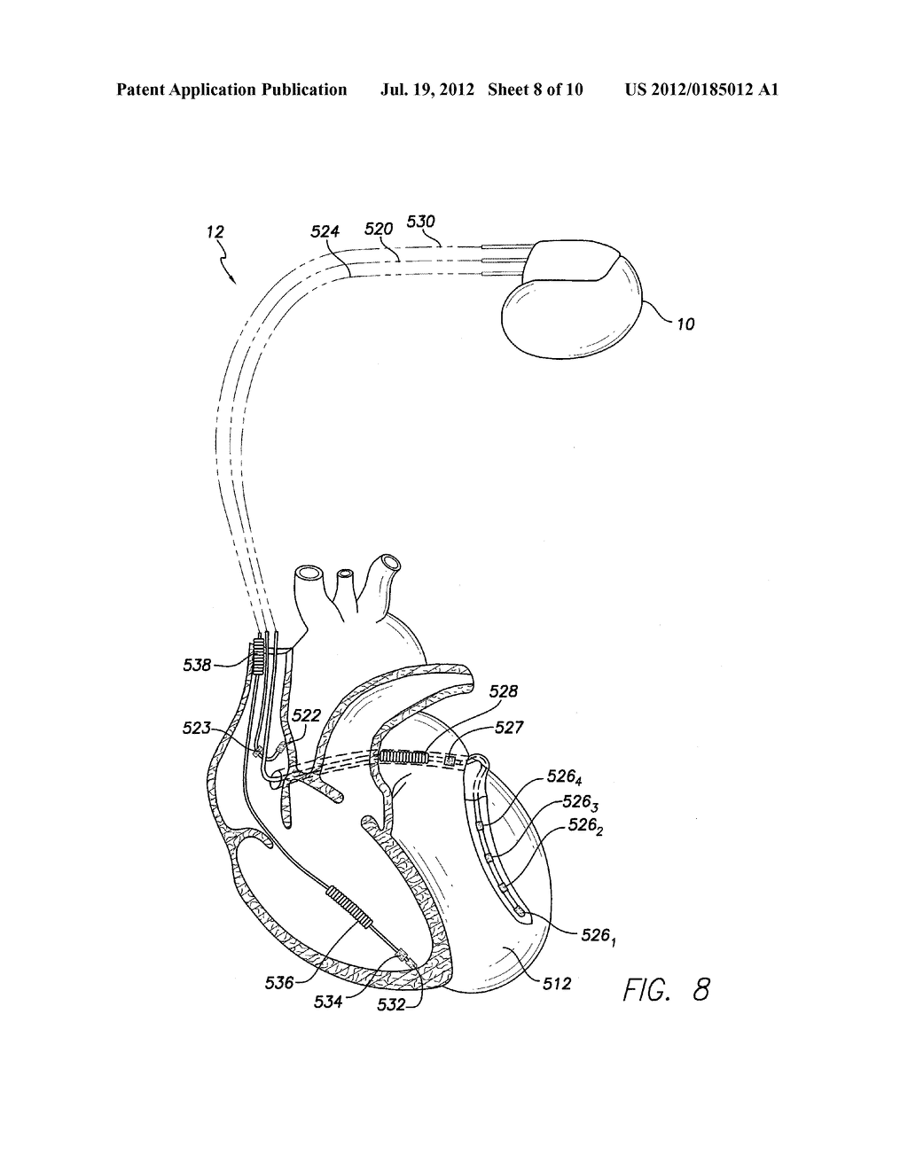 SYSTEMS AND METHODS FOR SELECTIVELY LIMITING MULTI-SITE VENTRICULAR PACING     DELAYS DURING OPTIMIZATION OF CARDIAC RESYNCHRONIZATION THERAPY     PARAMETERS - diagram, schematic, and image 09