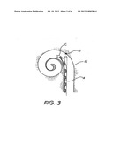 HYBRID COCHLEAR IMPLANT diagram and image