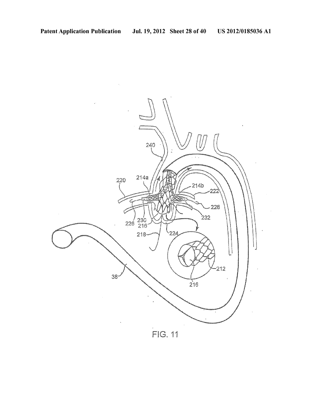 APPARATUS AND METHOD FOR DEPLOYING AN IMPLANTABLE DEVICE WITHIN THE BODY - diagram, schematic, and image 29