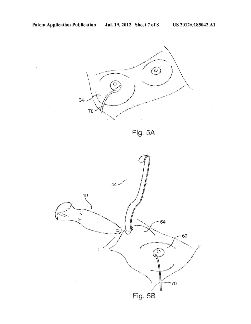 Fail-Safe Silicone Breast Implant Delivery Device - diagram, schematic, and image 08