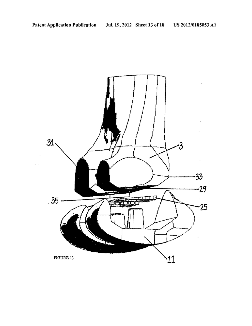 Spacer Apparatus and Method for Achieving Improved Fit and Balance in Knee     Joints - diagram, schematic, and image 14