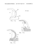 MEDIAL PIVOT POSTERIOR STABILIZED KNEE IMPLANT SYSTEM diagram and image