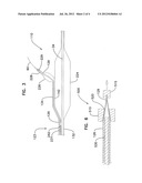 Joined Inflation Portions for Bifurcation Catheter diagram and image