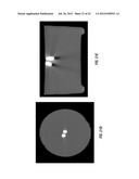 MRI Markers, Delivery and Extraction Systems, and Methods of Manufacture     and Use Thereof diagram and image