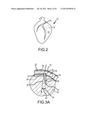 APPARATUS AND METHODS FOR SUPPORTING CARDIAC ISCHEMIC TISSUE BY MEANS OF     EMBEDDED STRUCTURES diagram and image