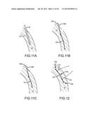 APPARATUS AND METHODS FOR SUPPORTING CARDIAC ISCHEMIC TISSUE BY MEANS OF     EMBEDDED STRUCTURES diagram and image