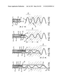 APPARATUS AND METHODS FOR SUPPORTING CARDIAC ISCHEMIC TISSUE BY MEANS OF     EMBEDDED STRUCTURES diagram and image