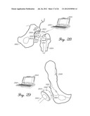 SENSORED PROSTHETIC COMPONENT AND METHOD diagram and image