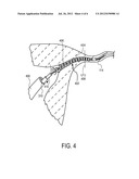 Methods and Devices For Determining Lumen Occlusion diagram and image