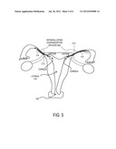 Methods and Devices For Determining Lumen Occlusion diagram and image