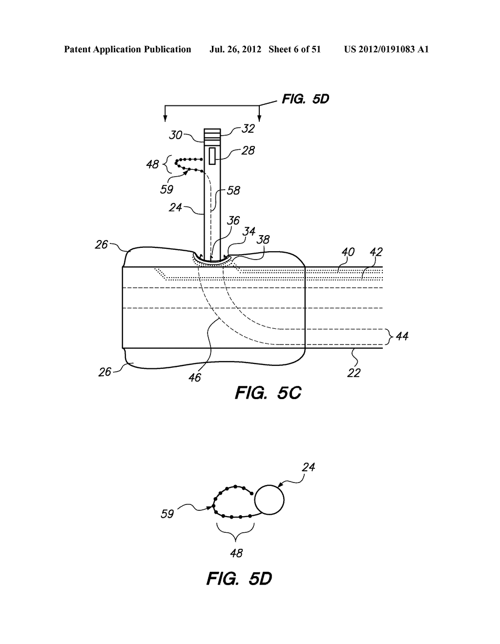 System and method for endoluminal and translumenal therapy - diagram, schematic, and image 07