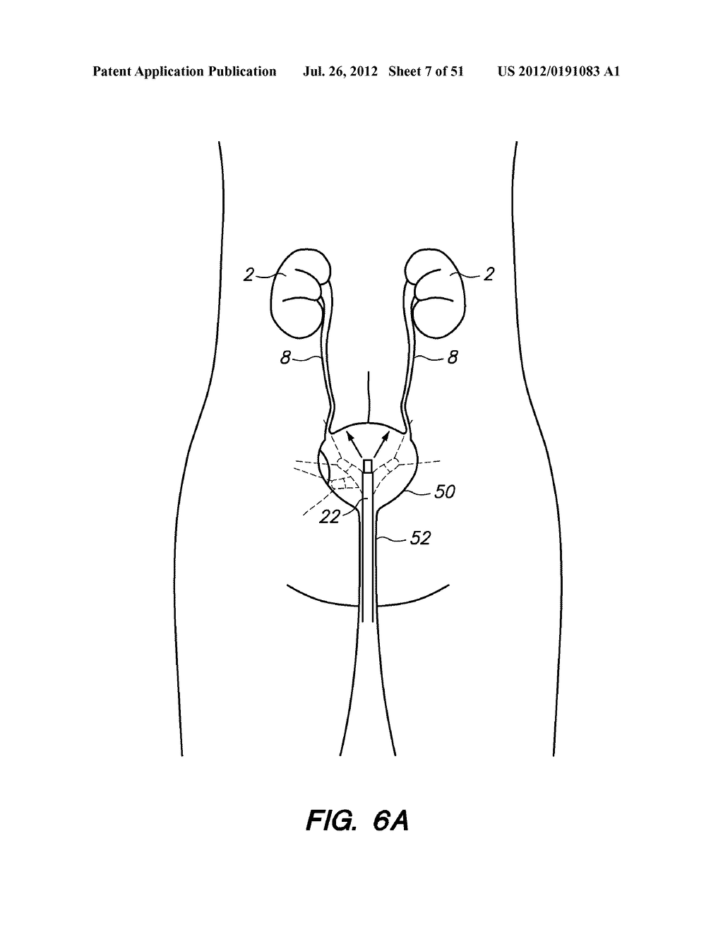 System and method for endoluminal and translumenal therapy - diagram, schematic, and image 08
