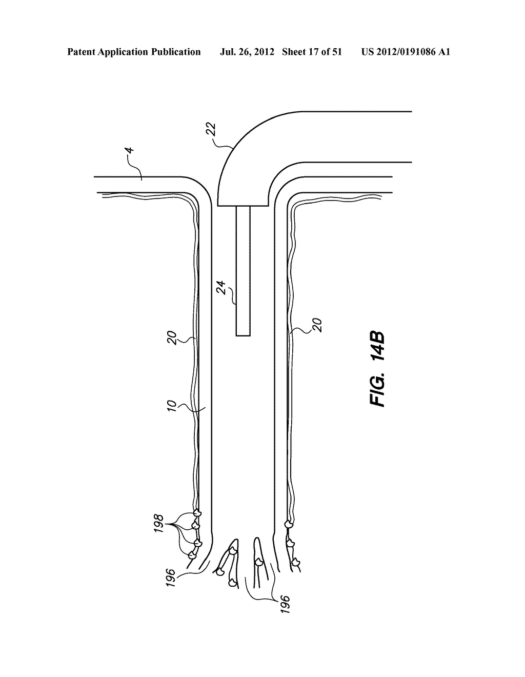 System and method for endoluminal and translumenal therapy - diagram, schematic, and image 18