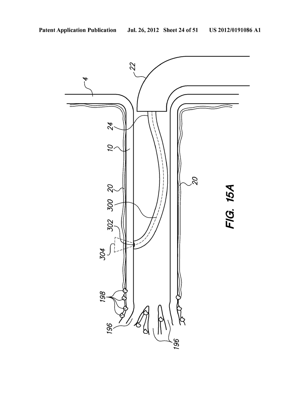 System and method for endoluminal and translumenal therapy - diagram, schematic, and image 25