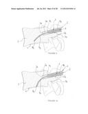 DRILLING DEVICE FOR FORMING A CURVED OSSEOUS CHANNEL WITHIN THE BODY OF A     VERTEBRA diagram and image