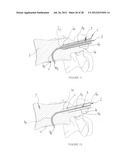 DRILLING DEVICE FOR FORMING A CURVED OSSEOUS CHANNEL WITHIN THE BODY OF A     VERTEBRA diagram and image