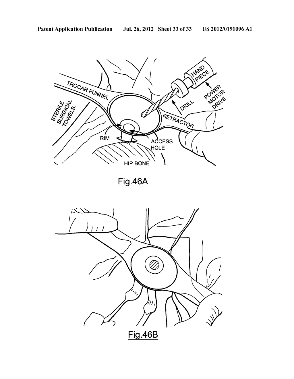 Bone Harvesting Device - diagram, schematic, and image 34