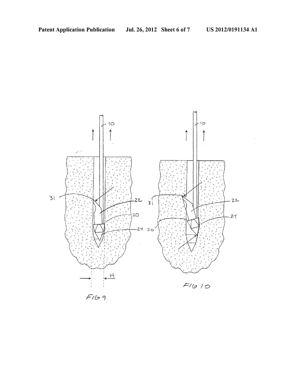METHODS AND DEVICES FOR ANCHORING SUTURE IN BONE - diagram, schematic, and image 07