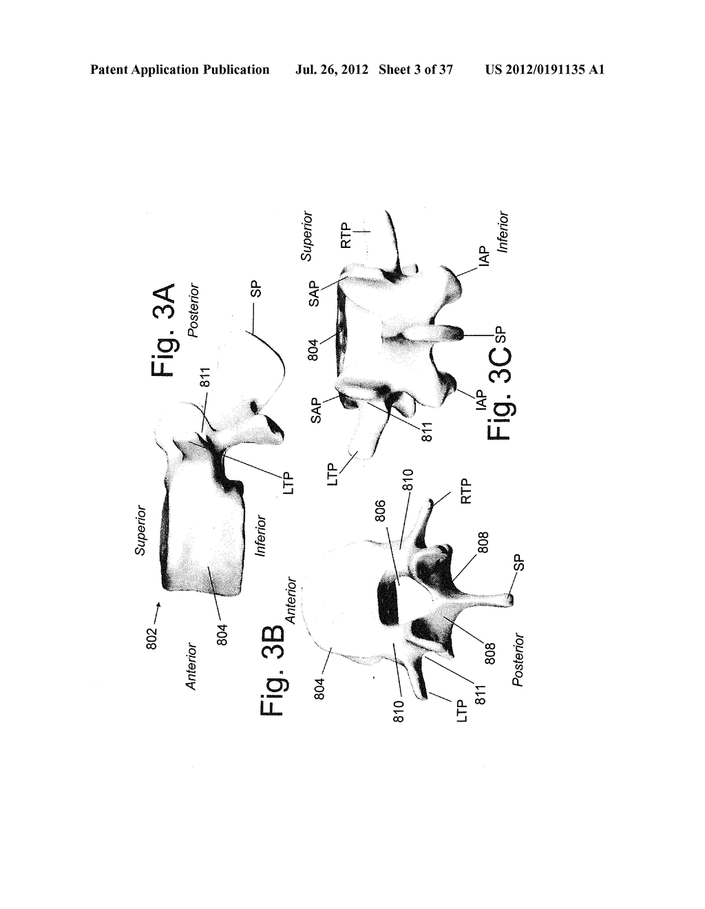 SPINOUS PROCESS FIXATION DEVICES AND METHODS OF USE - diagram, schematic, and image 04