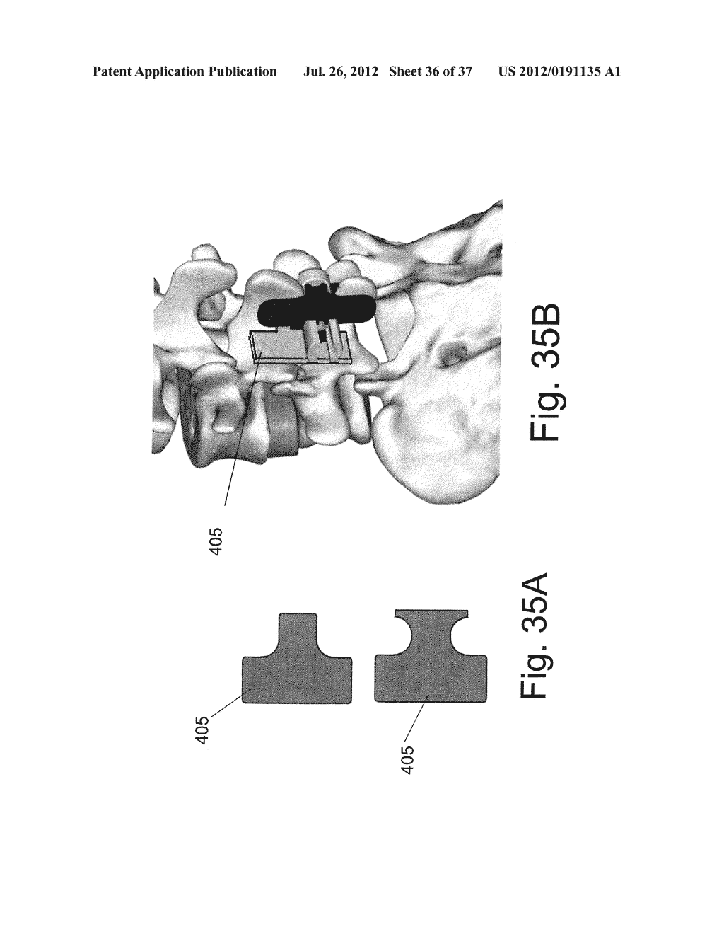 SPINOUS PROCESS FIXATION DEVICES AND METHODS OF USE - diagram, schematic, and image 37