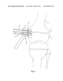 METHODS FOR BONE ALIGNMENT diagram and image