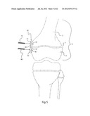 METHODS FOR BONE ALIGNMENT diagram and image