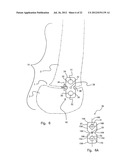 METHODS FOR BONE ALIGNMENT diagram and image