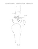 METHODS FOR BONE ALIGNMENT diagram and image