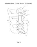 METHODS FOR BONE ALIGNMENT diagram and image