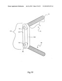 METHODS FOR BONE ALIGNMENT diagram and image