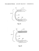 METHODS FOR BONE ALIGNMENT diagram and image