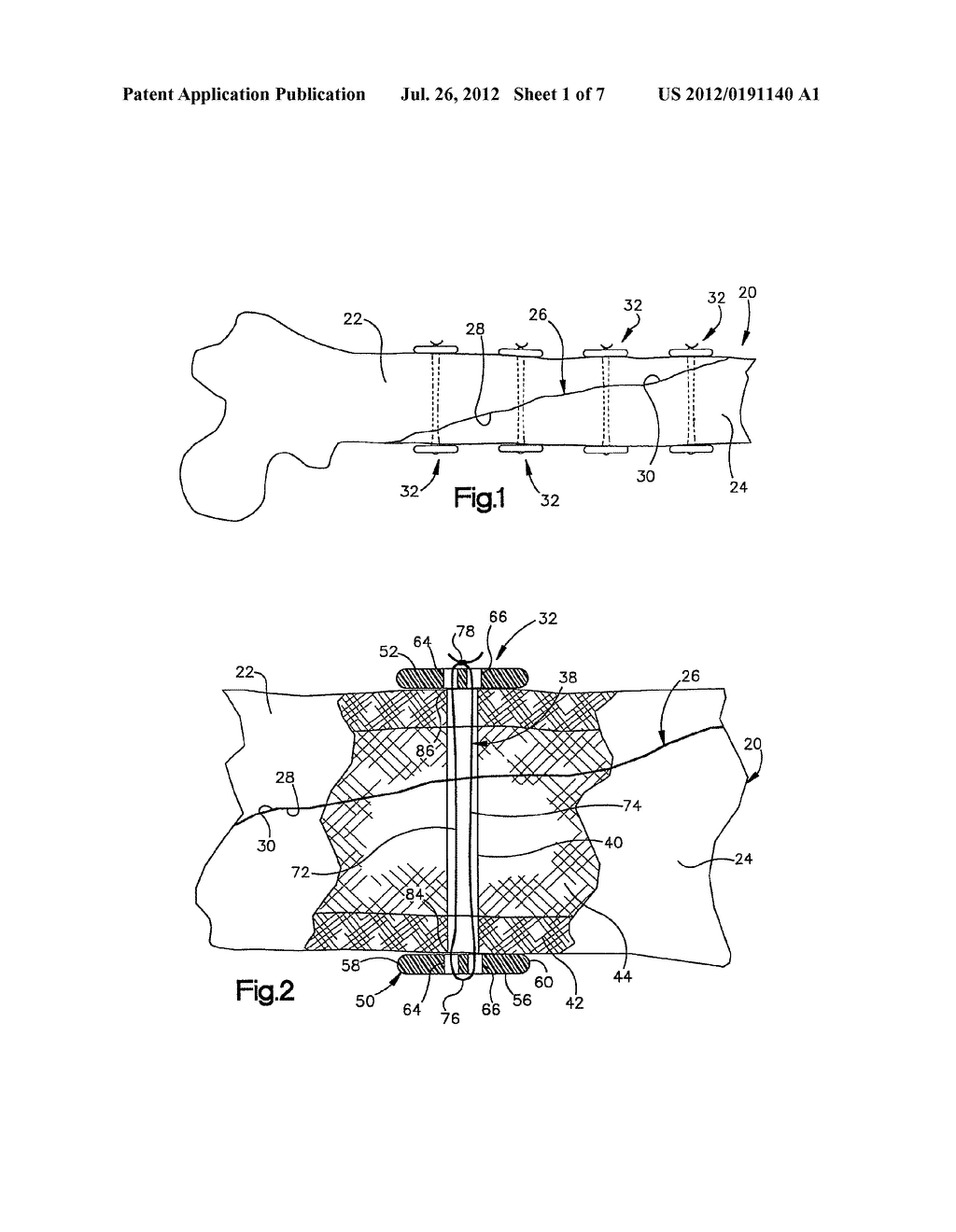 APPARATUS AND METHOD FOR SECURING A PORTION OF A BODY - diagram, schematic, and image 02