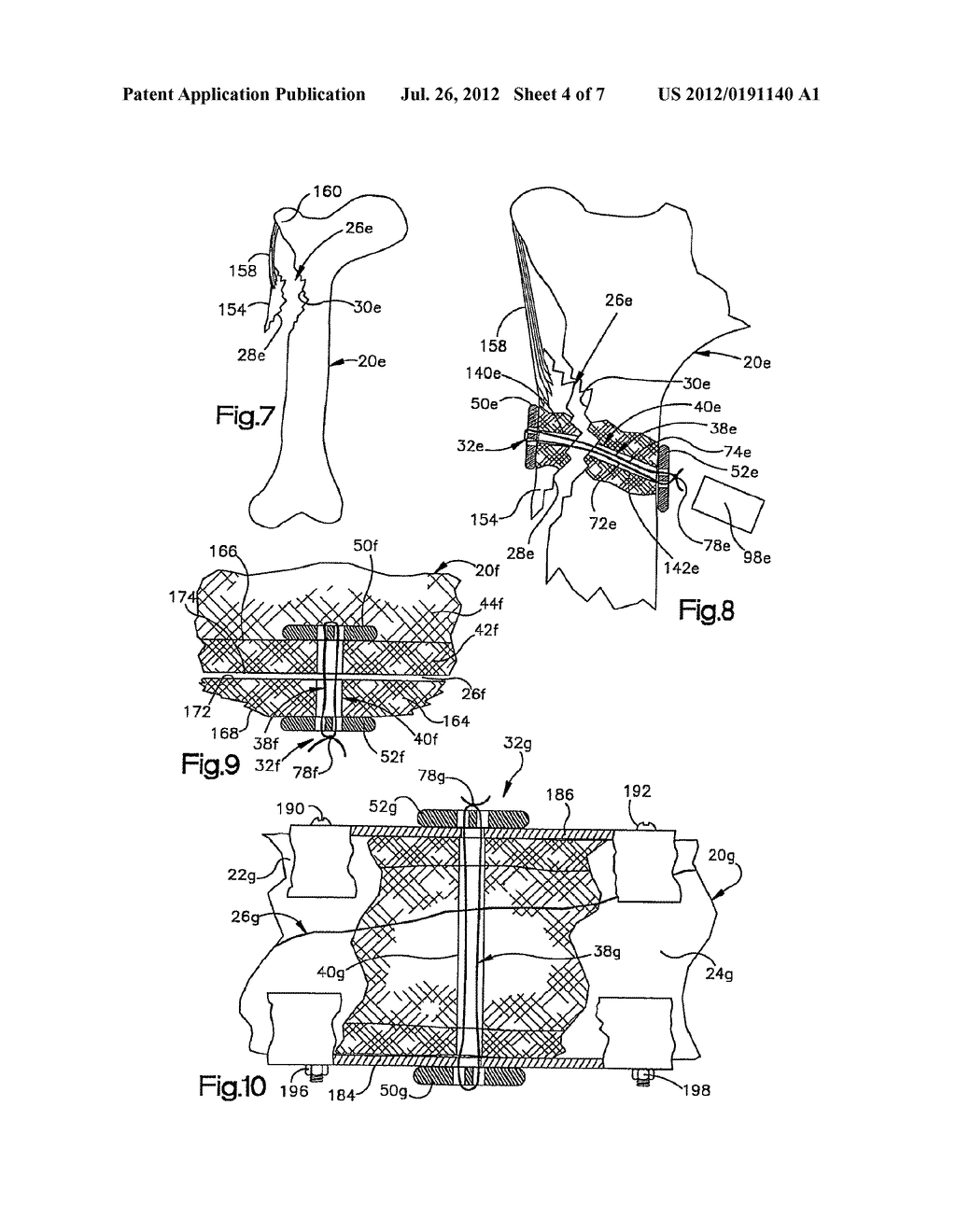 APPARATUS AND METHOD FOR SECURING A PORTION OF A BODY - diagram, schematic, and image 05