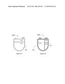 IMPLANTABLE CARDIAC DEVICES AND METHODS diagram and image