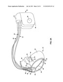 DIAGNOSIS OF LEAD FRACTURE AND CONNECTION PROBLEMS diagram and image