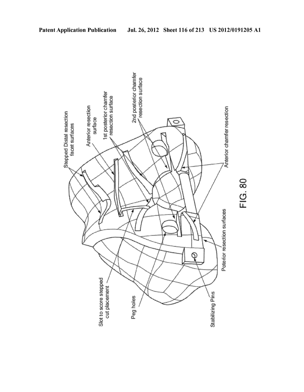 Patient-adapted and improved articular implants, designs and related guide     tools - diagram, schematic, and image 118