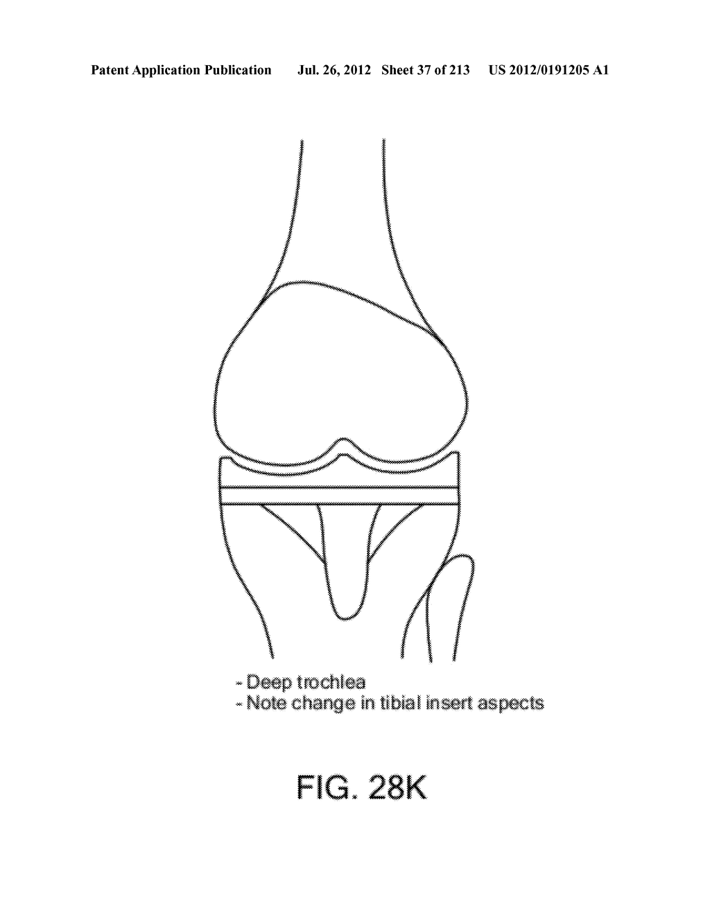 Patient-adapted and improved articular implants, designs and related guide     tools - diagram, schematic, and image 39