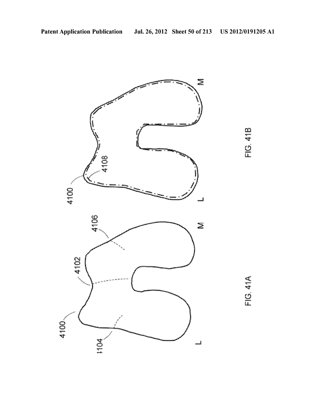 Patient-adapted and improved articular implants, designs and related guide     tools - diagram, schematic, and image 52