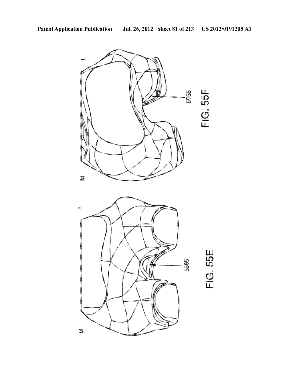 Patient-adapted and improved articular implants, designs and related guide     tools - diagram, schematic, and image 83