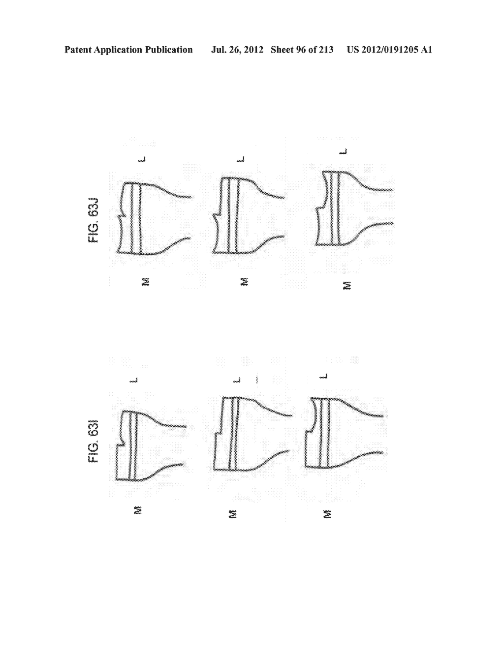 Patient-adapted and improved articular implants, designs and related guide     tools - diagram, schematic, and image 98