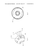 Spherical Subtalar Implant diagram and image