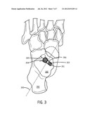 Spherical Subtalar Implant diagram and image