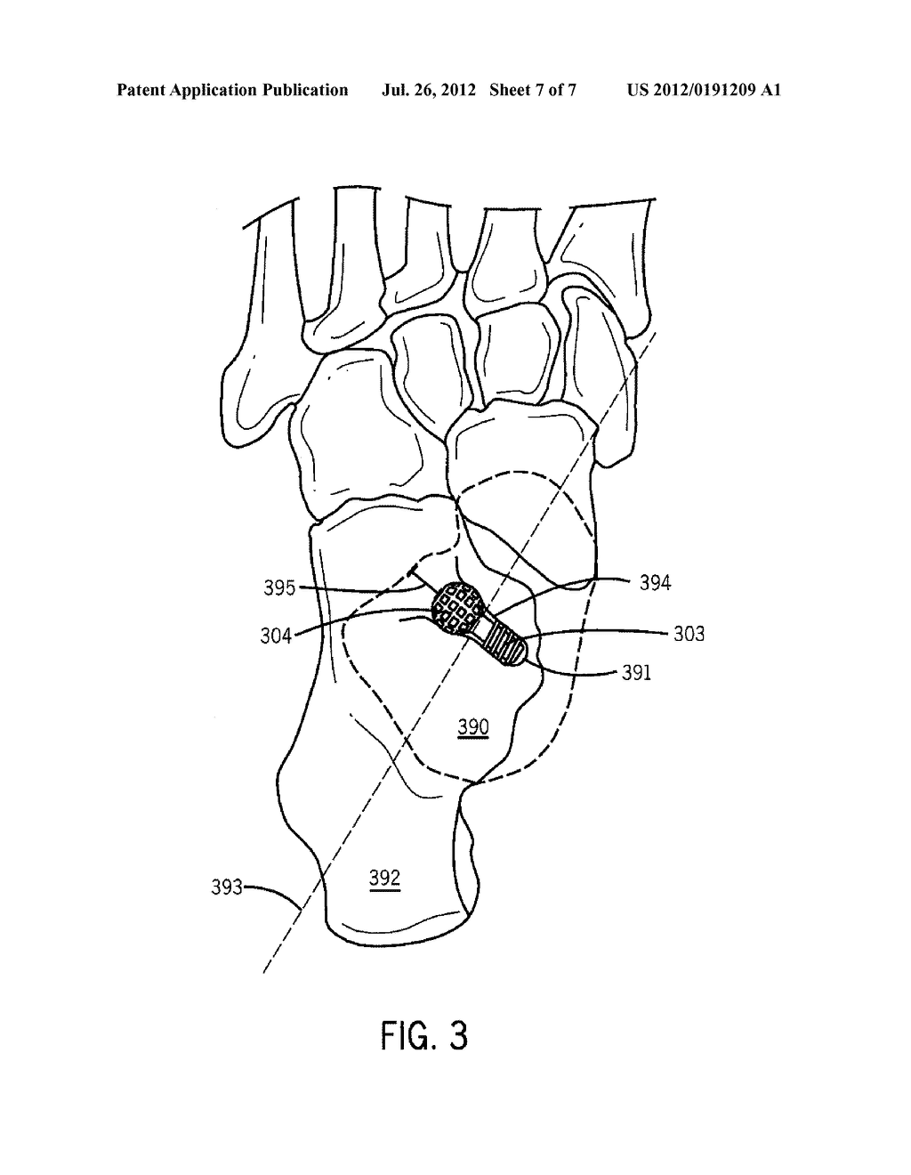 Spherical Subtalar Implant - diagram, schematic, and image 08