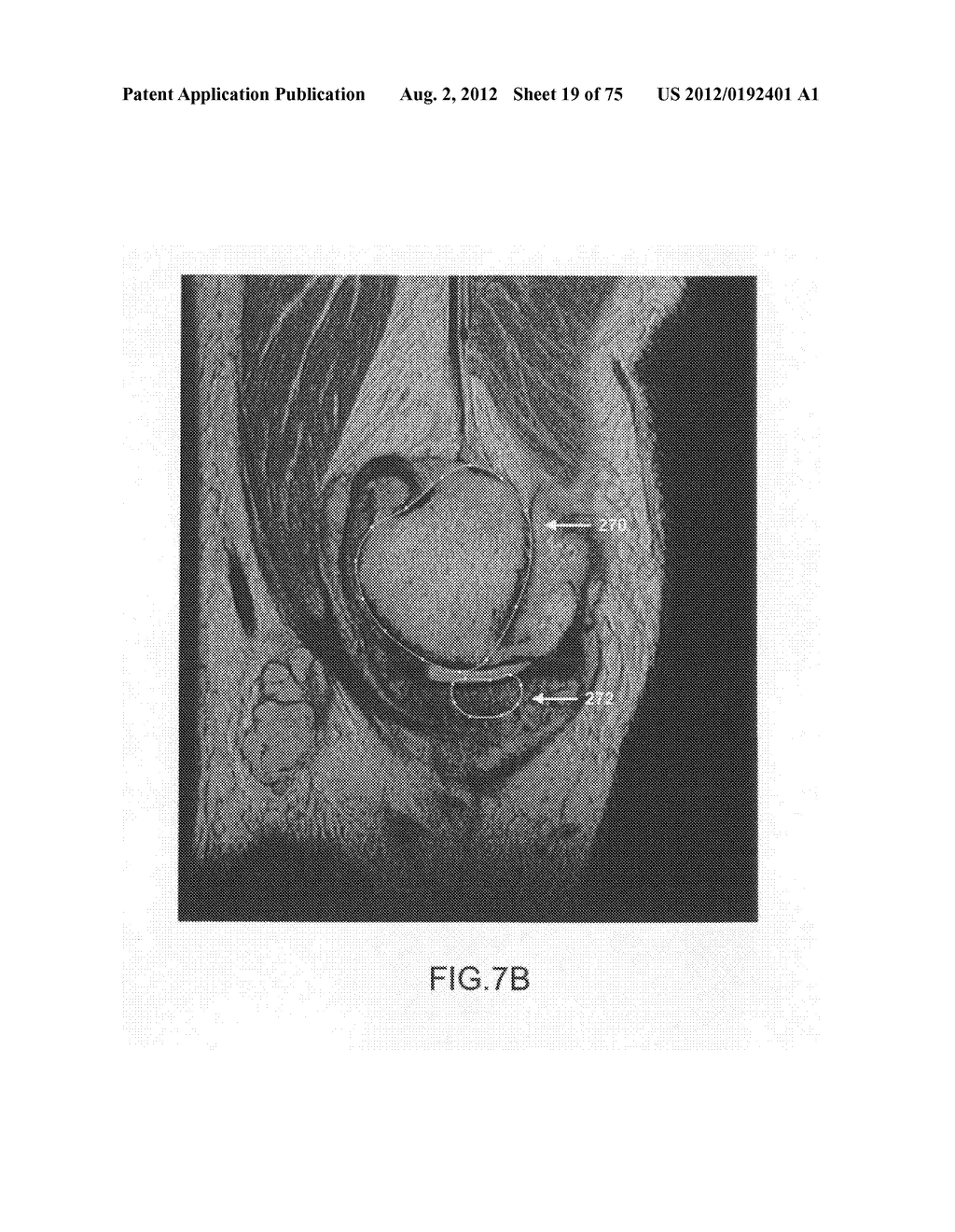 System and method for image segmentation in generating computer models of     a joint to undergo arthroplasty - diagram, schematic, and image 20