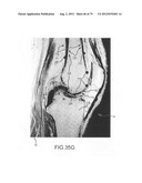 System and method for image segmentation in generating computer models of     a joint to undergo arthroplasty diagram and image