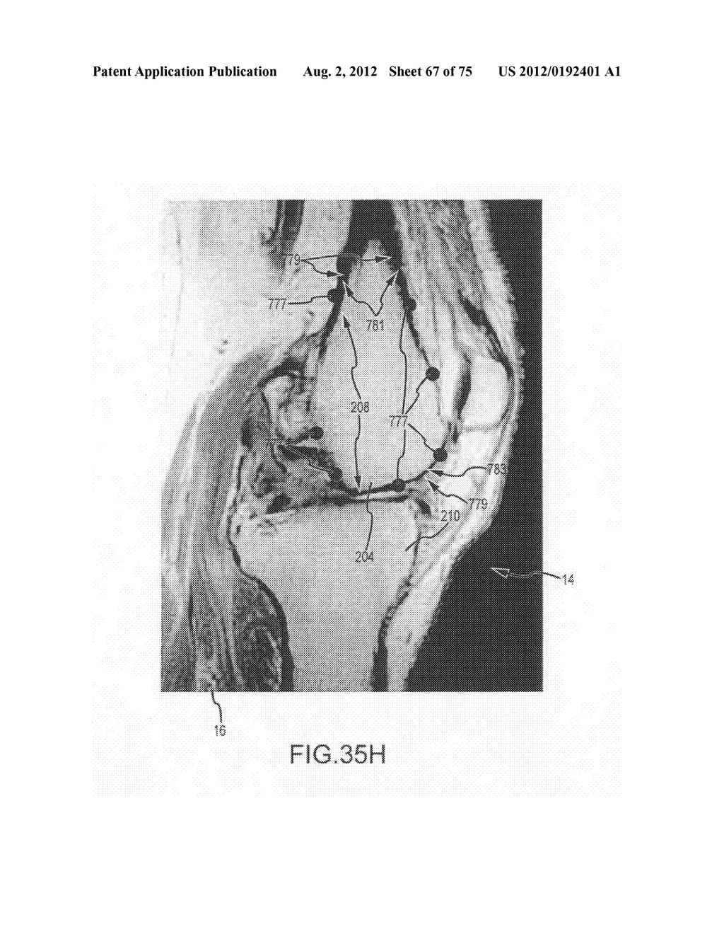 System and method for image segmentation in generating computer models of     a joint to undergo arthroplasty - diagram, schematic, and image 68