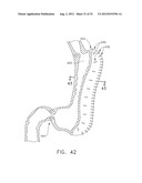 Surgical Stapler Having an Adjustment Feature diagram and image