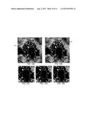 COMPUTER-AIDED DIAGNOSIS OF RETINAL PATHOLOGIES USING FRONTAL EN-FACE     VIEWS OF OPTICAL COHERENCE TOMOGRAPHY diagram and image