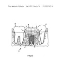 ANGLED DENTAL PLATFORM ASSEMBLY AND METHODS diagram and image