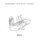 ANGLED DENTAL PLATFORM ASSEMBLY AND METHODS diagram and image